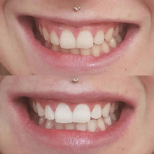 Load image into Gallery viewer, The Award Winning SNOW Teeth Whitening™ System