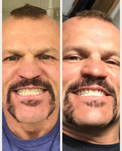 Load image into Gallery viewer, The Award Winning SNOW Teeth Whitening™ System