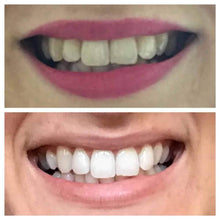 Load image into Gallery viewer, Snow® Teeth Whitening At-Home System [All-in-One Kit] - SPECIAL TV OFFER
