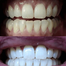 Load image into Gallery viewer, The Award Winning SNOW Teeth Whitening™ System
