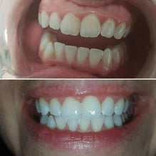 Load image into Gallery viewer, The Award Winning SNOW Teeth Whitening™ System
